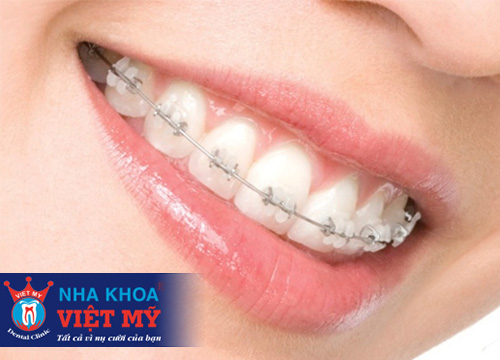 chỉnh nha - niềng răng tốt nhất tại pleiku