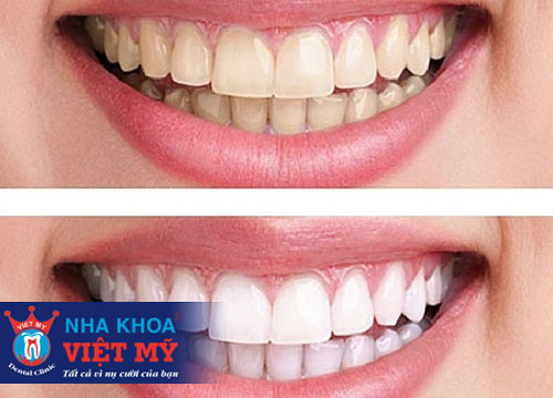 trung tâm nha khoa tẩy trắng răng uy tín tại Sa Huỳnh