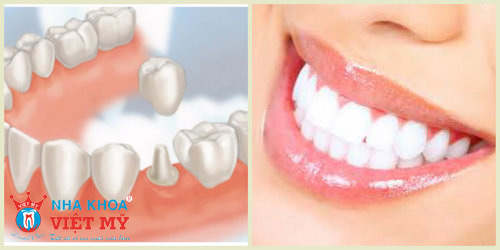 boc-rang-su-co-phai-lay-tuy-khong-2