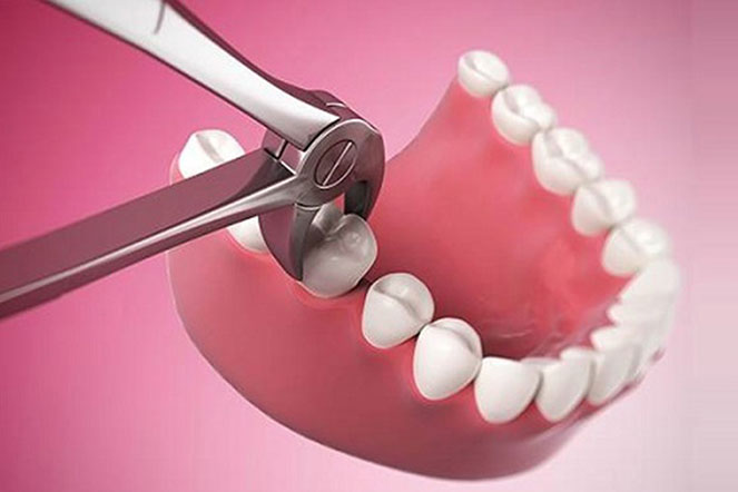 nhổ răng không đau