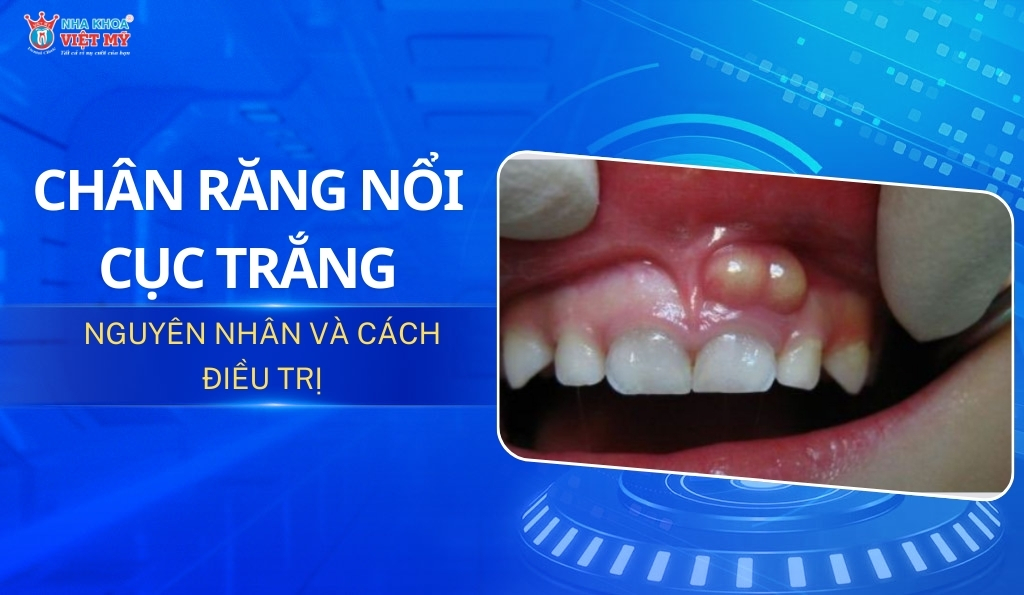 thumbnail chân răng nổi cục trắng