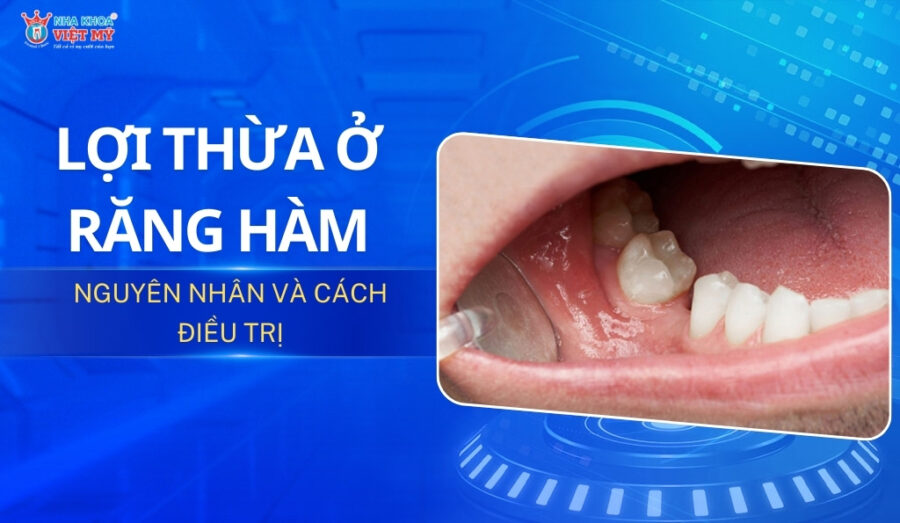 thumbnail lợi thừa ở răng hàm