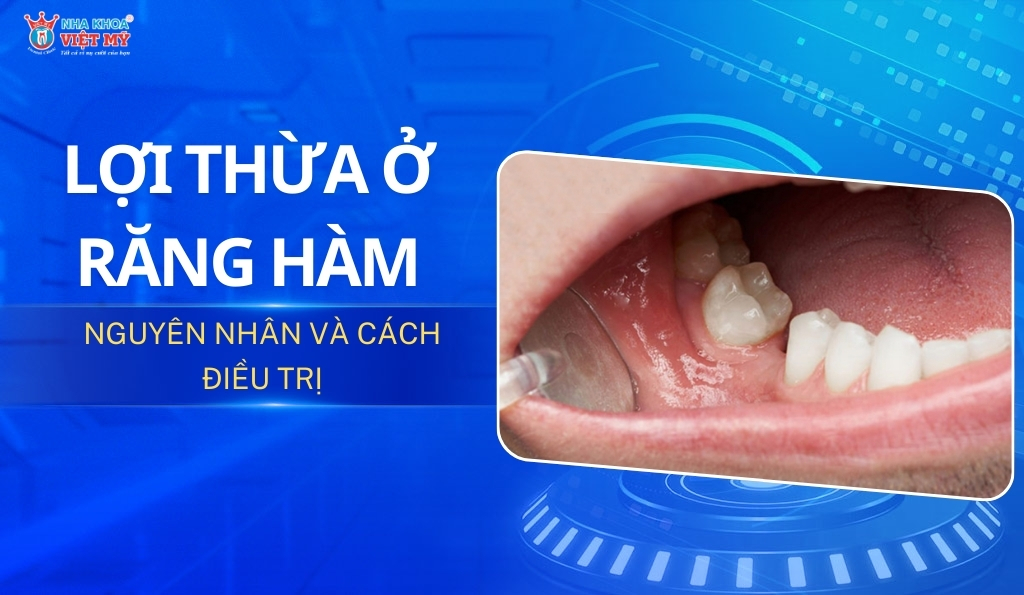 thumbnail lợi thừa ở răng hàm
