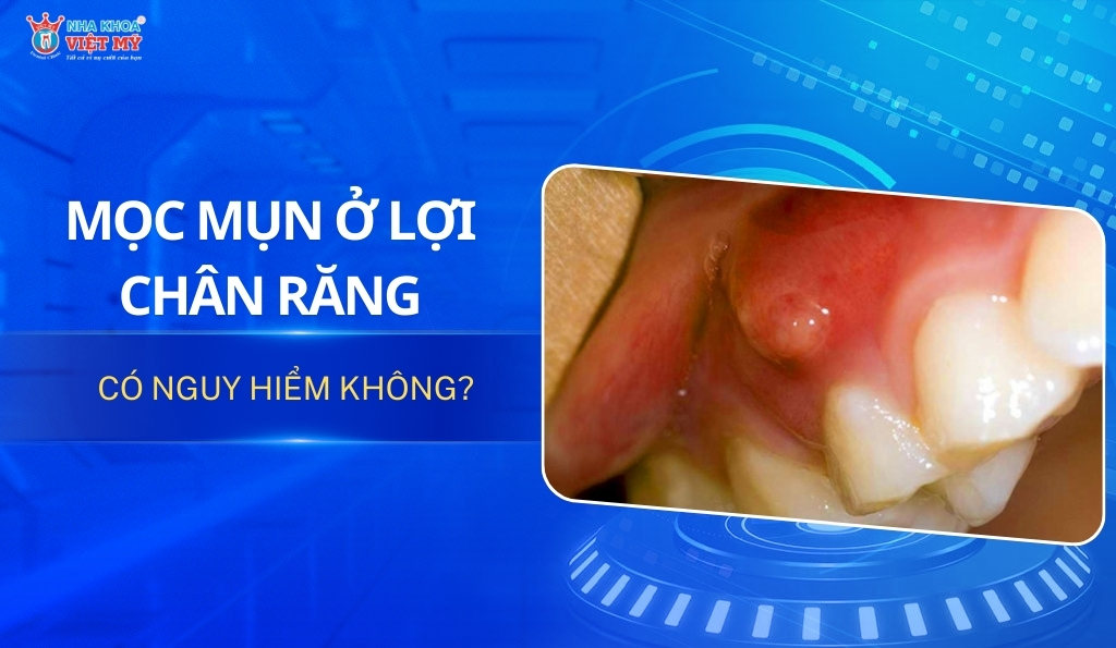 thumbnail mọc mụn ở lợi chân răng