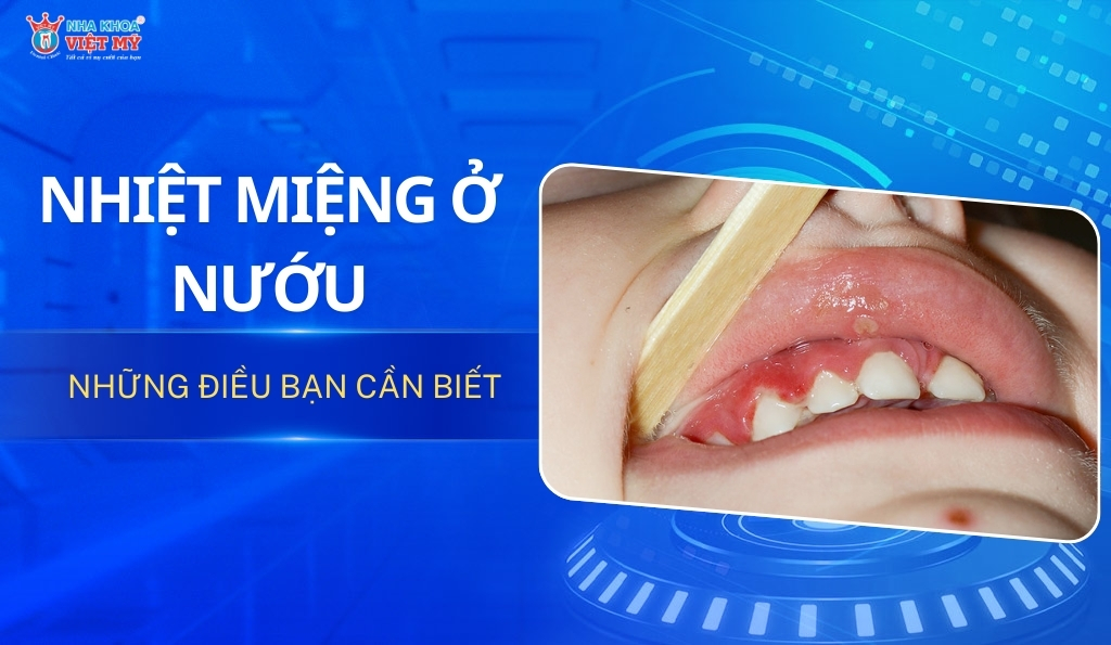 thumbnail nhiệt miệng ở nướu