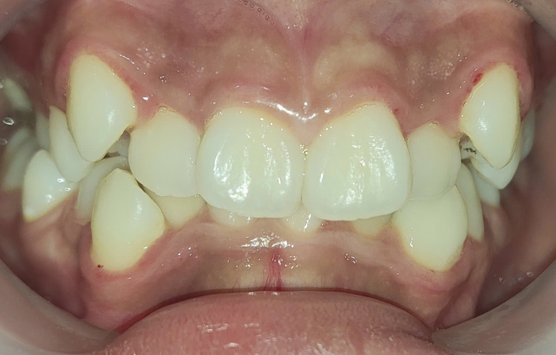 Khánh Linh trước khi niềng răng tại Nha Khoa Việt Mỹ