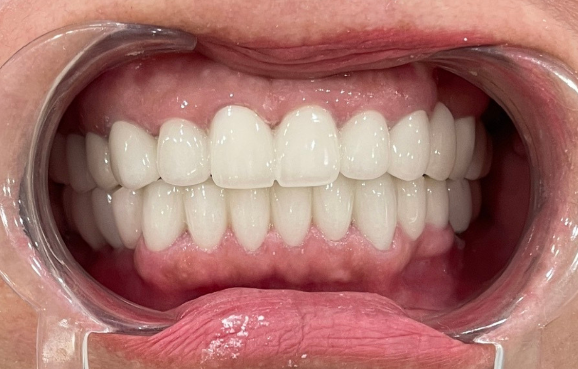 KH. Ngọc Dung sau làm răng tại nha khoa Việt Mỹ