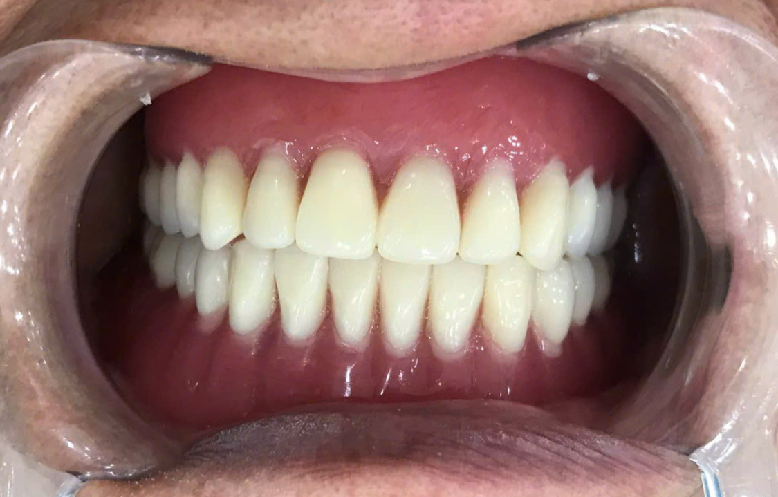 Khách hàng Đỗ Thị Mười sau khi điều trị tại nha Khoa Việt Mỹ