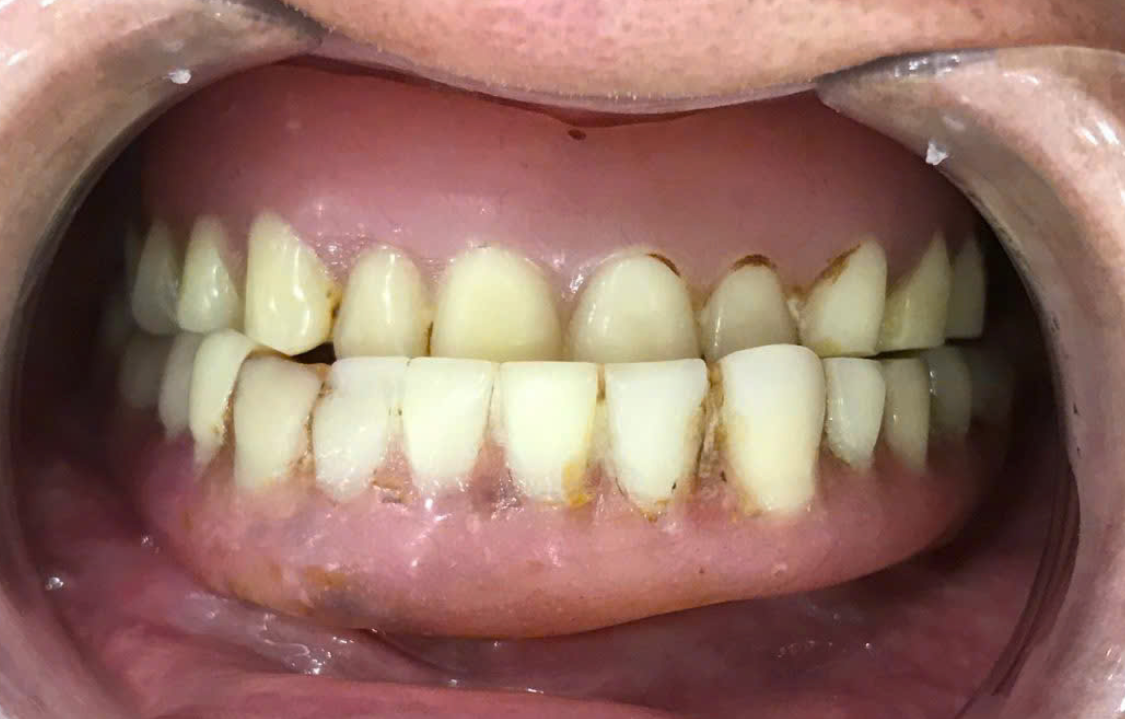 Khách hàng Đỗ Thị Mười trước khi điều trị tại nha Khoa Việt Mỹ